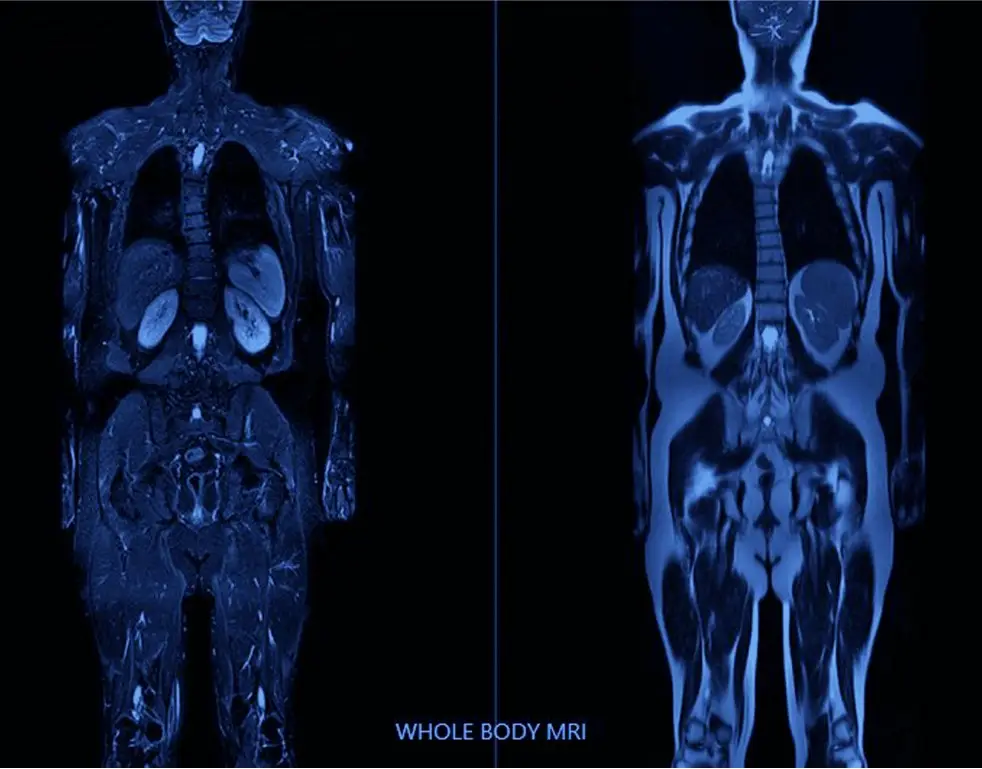 Dexa Body Composition Scan - Accurate Imaging Diagnostics DEXA at Accurate  Imaging Diagnostics