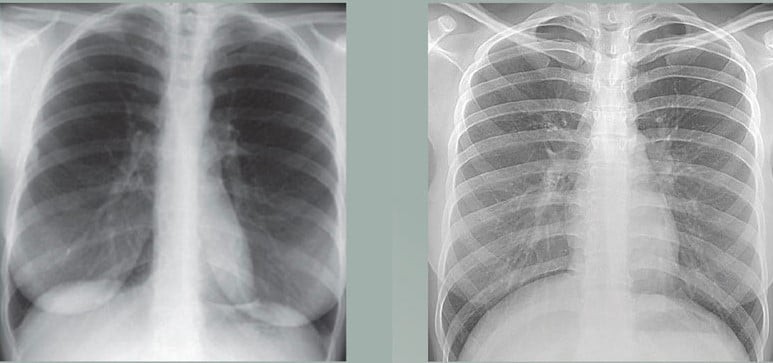 See The Difference? Before & After X-Rays Are Proof That What We Do Works!